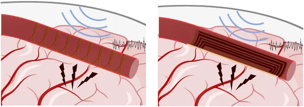 Wireless devices with spiral or flat coils used to stimulate and record brain activity.