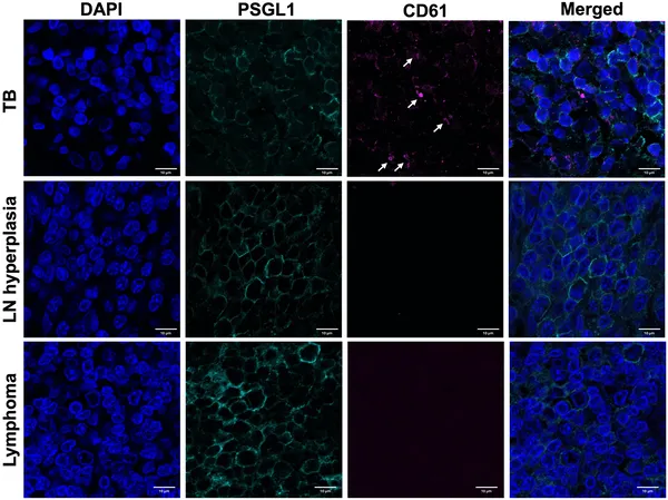 Platelets cluster on certain immune cells in TB-infected lymph nodes but not in non-TB lymph node diseases, shown by special staining and microscopy.